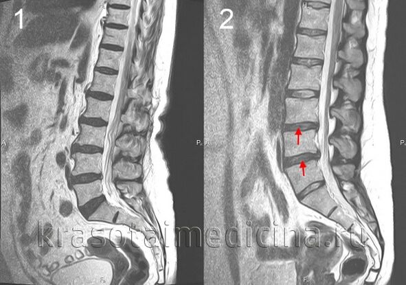 Osteocondrose da columna vertebral