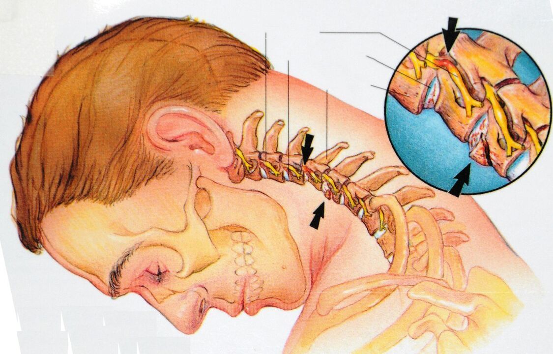 Osteocondrose da rexión cervical